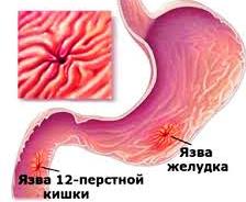 Перед тем как пойдут месячные болит живот