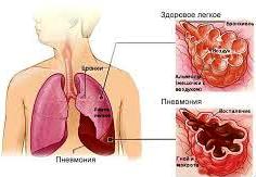 Турция воспаление легких