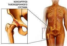 Лечение коксартроза тазобедренного сустава в чехии